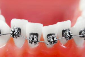 orthodontic treatment